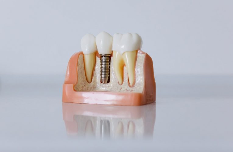 Zašto su zubni implanti toliko skupi?